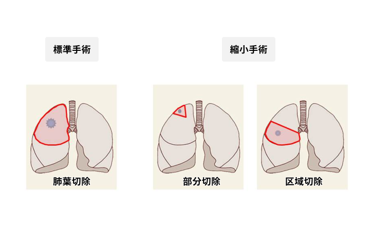 完全胸腔鏡下手術が適応となる主な切除術