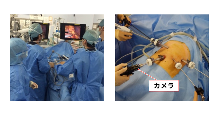 胃がん〜mSOFY法で術後の生活の質を向上させる〜 | 日本赤十字社 胃がん〜mSOFY法で術後の生活の質を向上させる〜 | 日本赤十字社