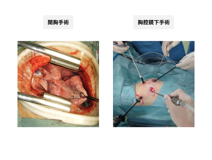 胸腔鏡下手術と完全胸腔鏡下手術の違い