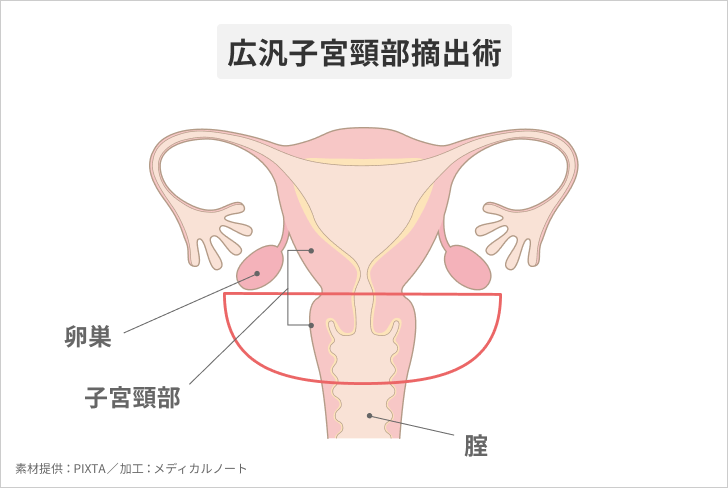 腹腔鏡下での広汎子宮頸部摘出術