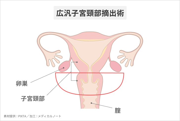 子宮頸がん～質・量ともに国内トップクラスの子宮頸がん手術