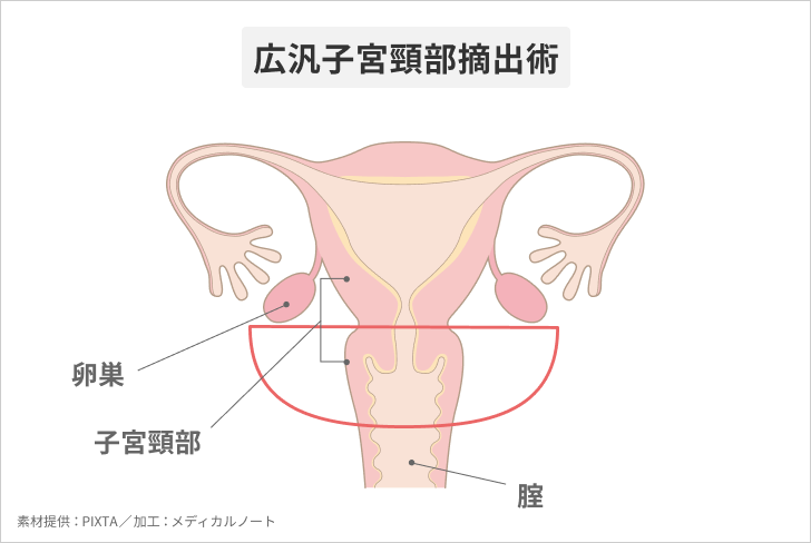 超歓迎された】 【裁断済】広汎子宮全摘術と広汎子宮頸部摘出術 健康 