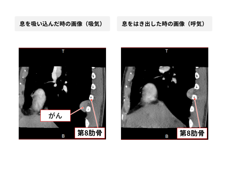 肺がん〜4次元の胸部CTを用いた術前診断の工夫〜 | 学校法人 日本大学 