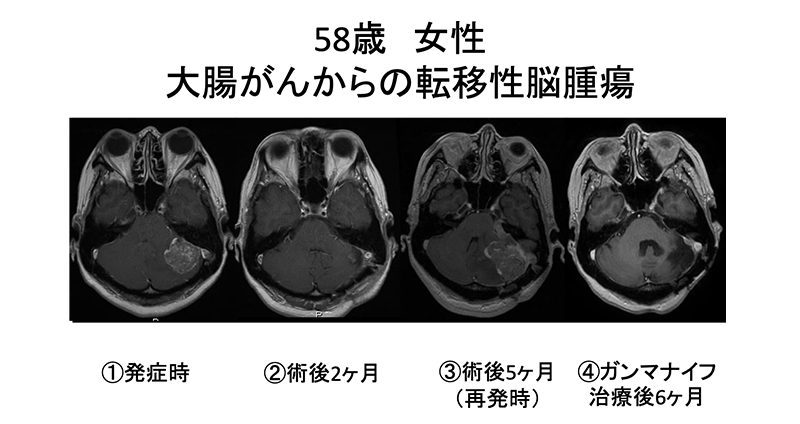 術後5か月後に再発をした患者さん